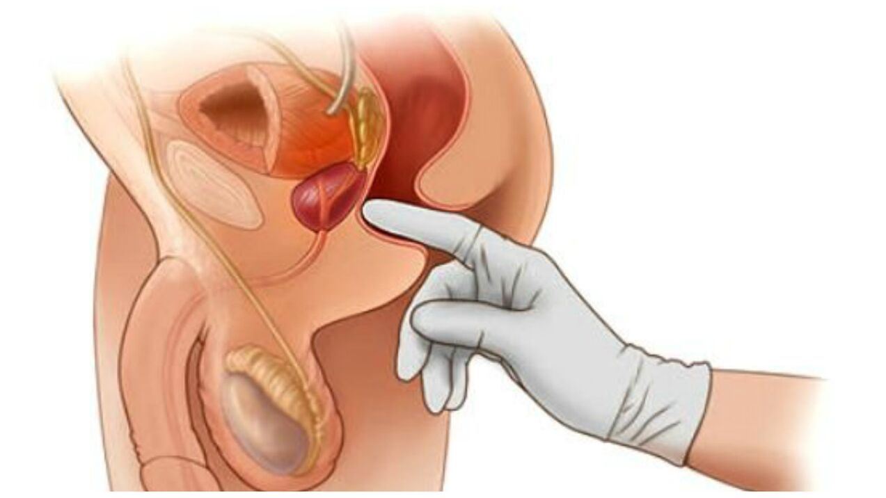 masaje de prostata para la prostatitis cronica