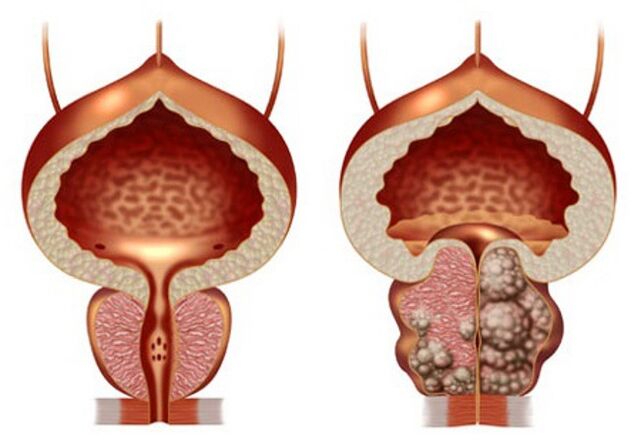 próstata sana y adenoma de próstata