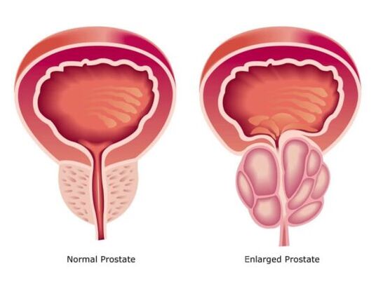 Próstata normal y agrandada
