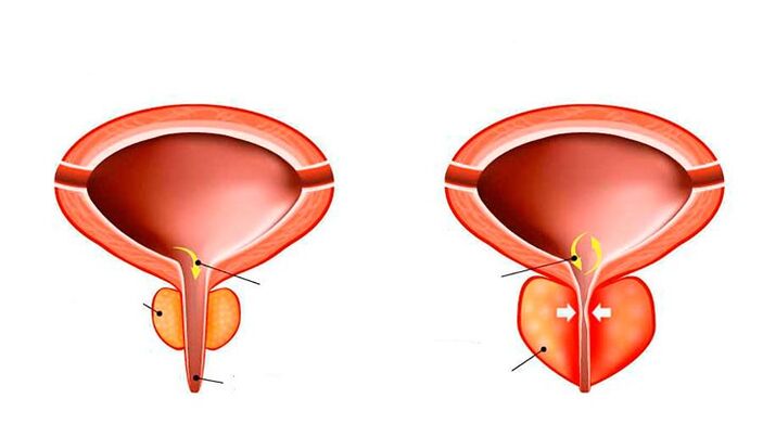 próstata normal e inflamada